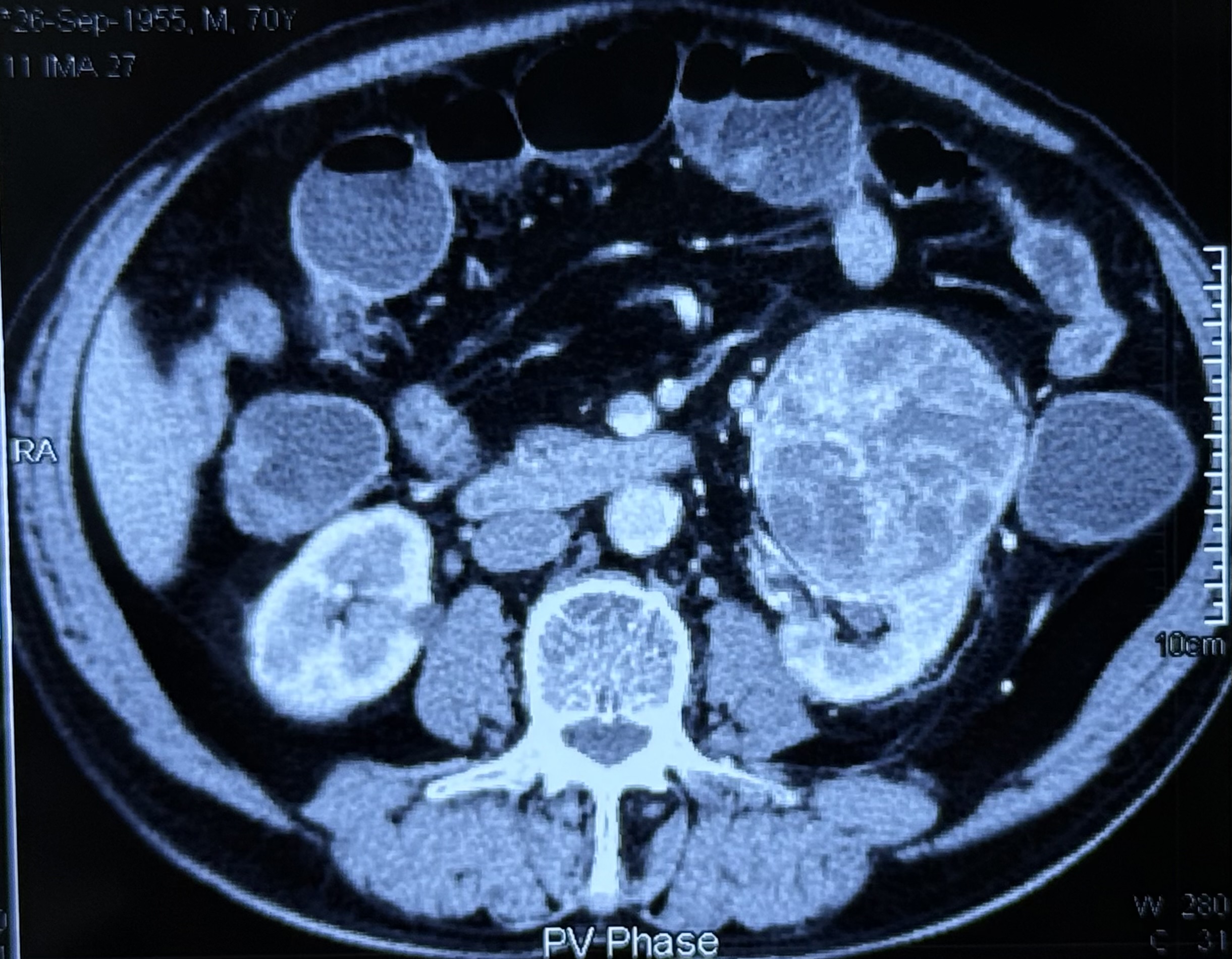 Breakthrough Treatment