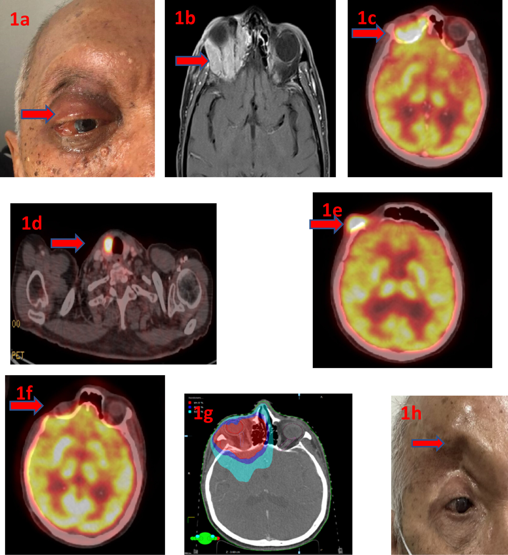 Case Report: Primary Squamous Cell Carcinoma of the Orbit in a Patient With Carney's Syndrome Treated With Multidisciplinary Approaches
