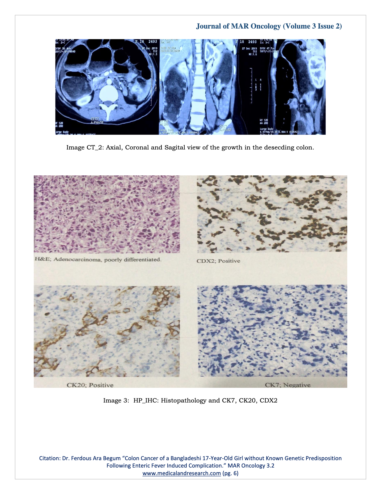 Colon Cancer of a Bangladeshi 17-Year-Old Girl without Known Genetic Predisposition Following Enteric Fever Induced Complication.