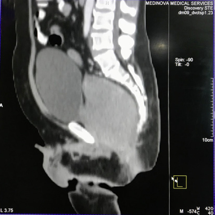 Primary Rectal Non-Hodgkin's Lymphoma Treated with Urgent Radiotherapy and Chemotherapy: A Case Report and Literature Review
