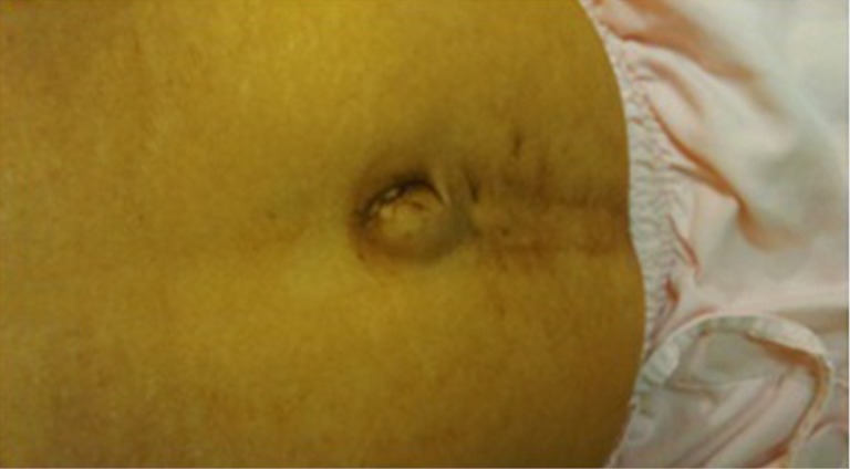 Sister Mary Jospeh's nodule as initial presentation of carcinoma caecum-case report and literature review
